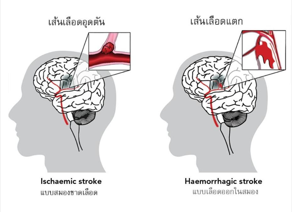 การฟื้นฟูสมองภายหลังเกิด Stroke ด้วย NMN