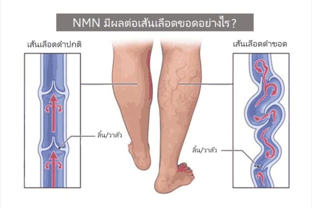 NMN มีผลต่อเส้นเลือดขอดอย่างไร?