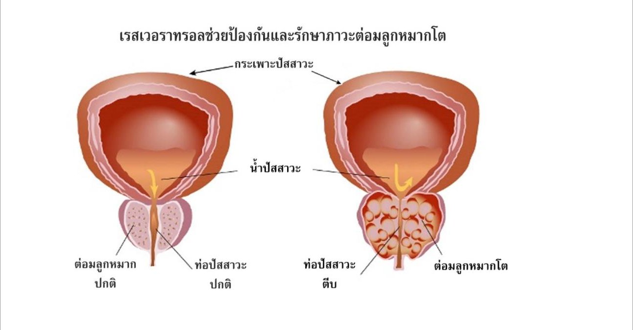 เรสเวอราทรอลช่วยป้องกันและรักษาภาวะต่อมลูกหมากโต