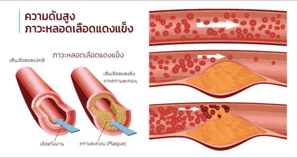 สาร Senolytics (ตอนที่ 2) ยับยั้งการเกิดคราบตะกอนในเส้นเลือด